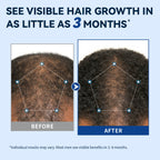 5% Minoxidil Solution