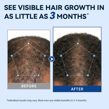 AvitaPure Men's 5% Minoxidil Hair Growth Spray